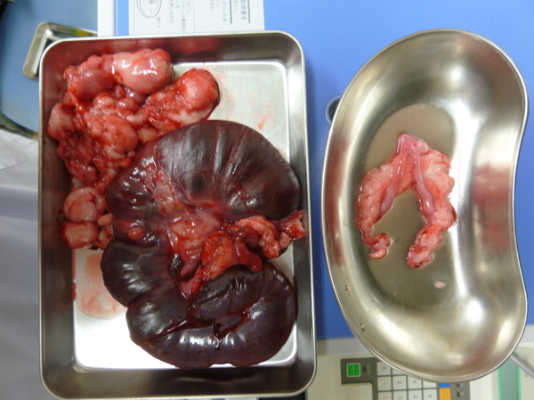 子宮内膜瘤・子宮腺癌の大網転移、正常な卵巣子宮.JPG